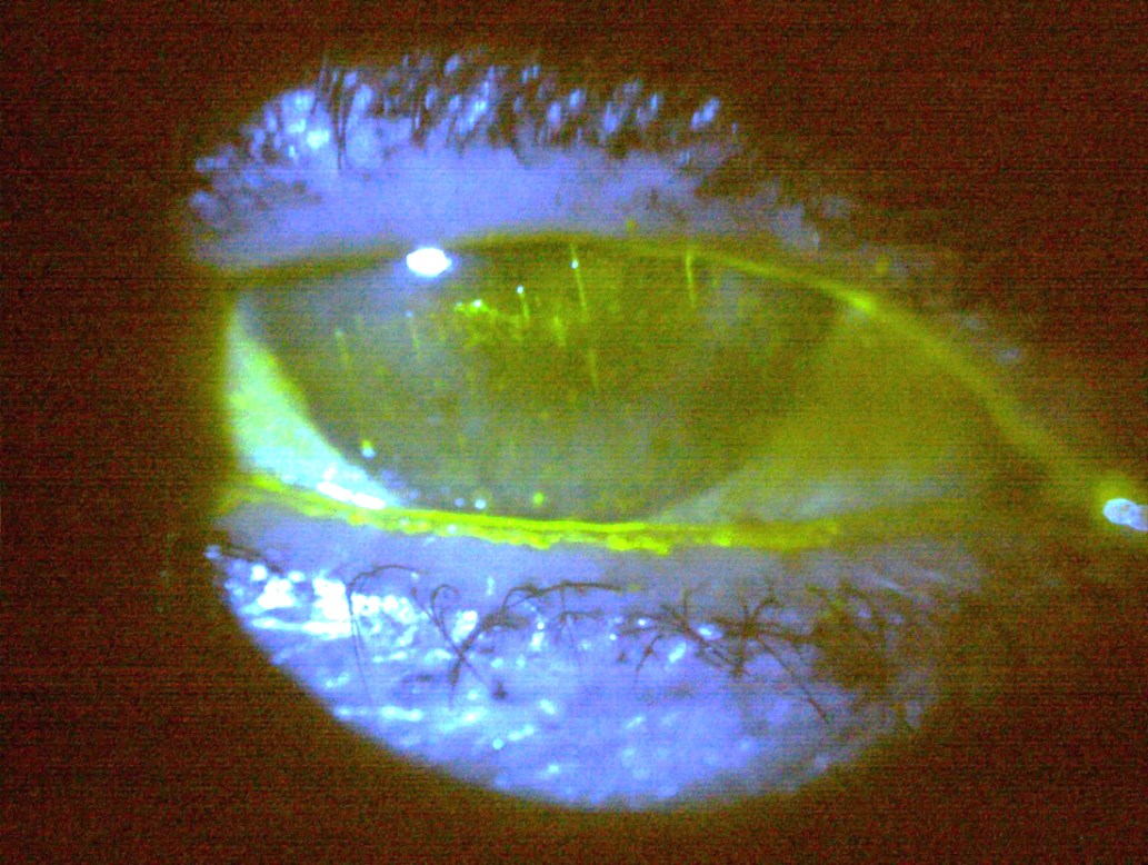 Case 5 - fluorescein staining with mucus strands