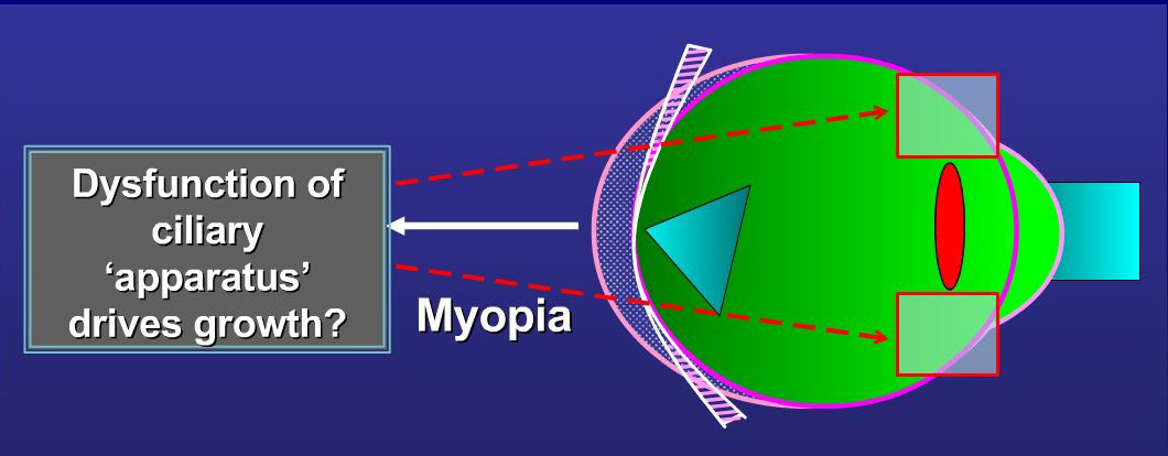 Diagram of a myopic eye with dysfunction of the ciliary apparatus driving growth
