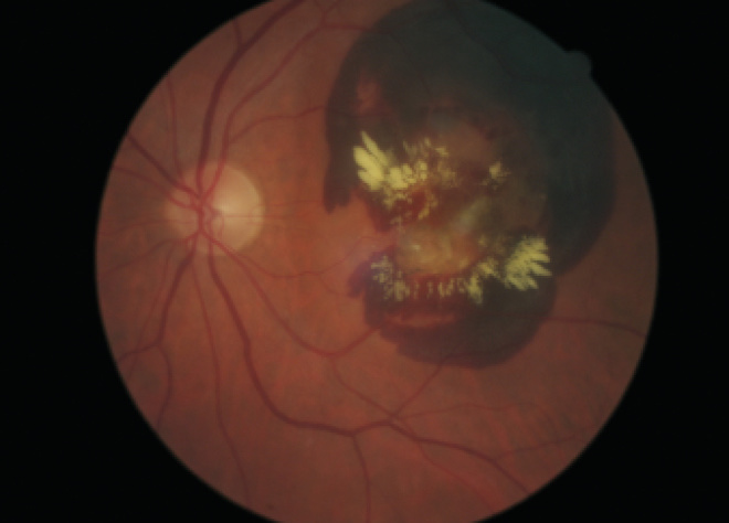 Fundus photo of CNVM with severe sub-retinal haemorrhage