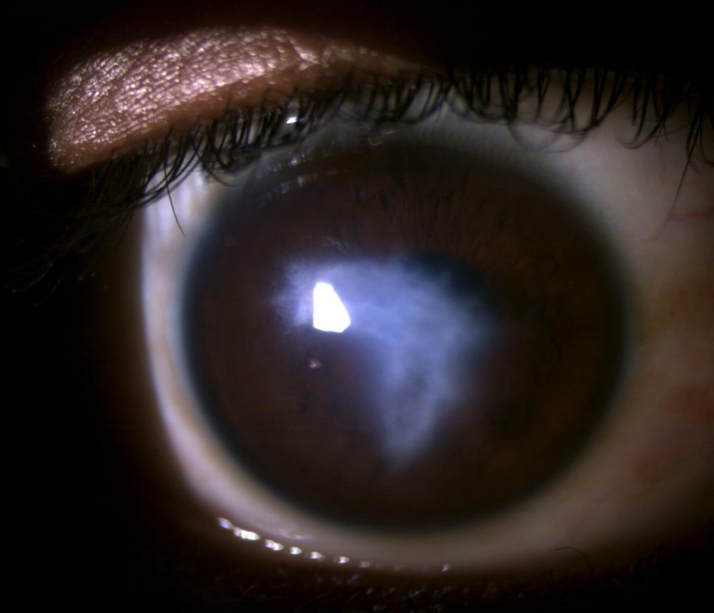 Close-up of the eye showing the central corneal opacity