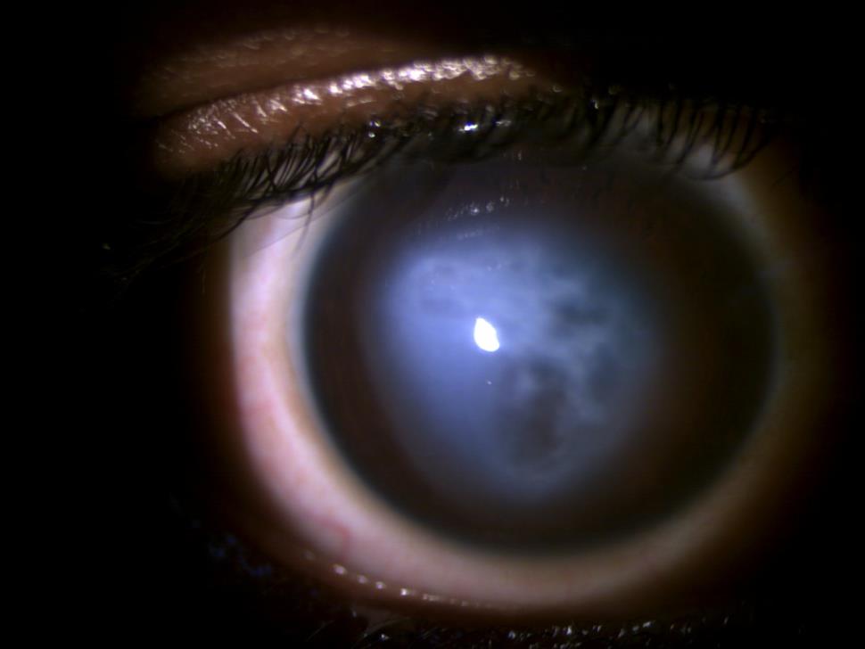 Eye with corneal hydrops, diffuse illumination