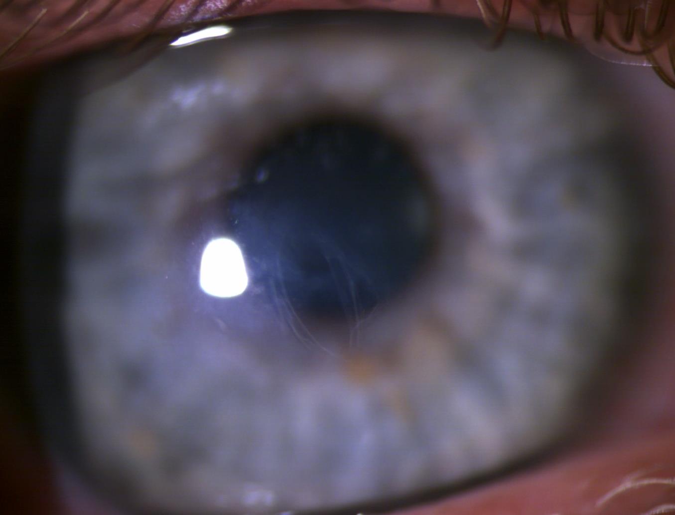 Close-up photo of the cornea at the last visit