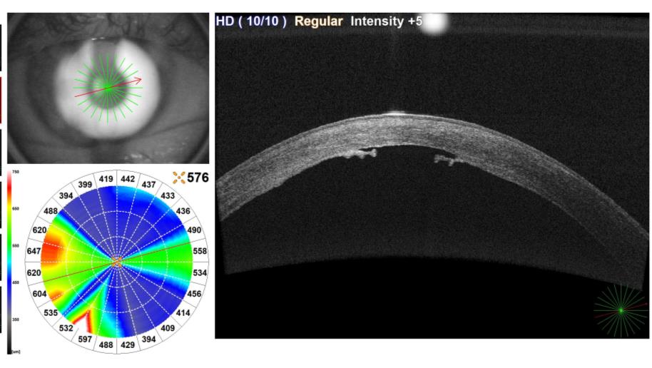 OCT scan and pachymetry map of the cornea at the last visit