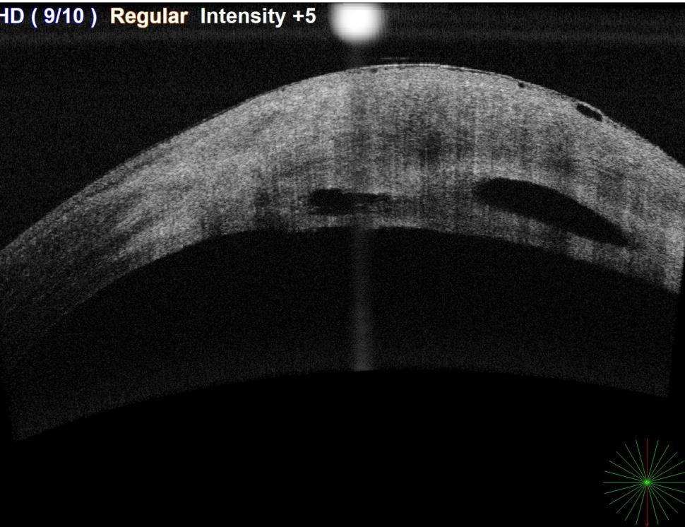 OCT of the cornea showing fluid-filled pockets in the stroma