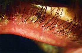 Eyelid margin with crusting at the base of the lashes in demodex blepharitis