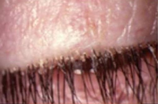 Eyelashes with crusting at the lash bases