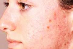 Redness and lesions on the cheek