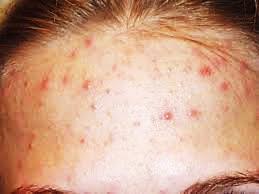 Inflammatory lesions on the forehead