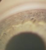 Gonioscopy view of the angle
