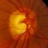Photograph of the optic nerve head