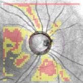 Retinal nerve fibre layer imaging around the optic disc