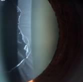 Slit lamp optical section