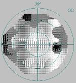 Visual field printout with field defects