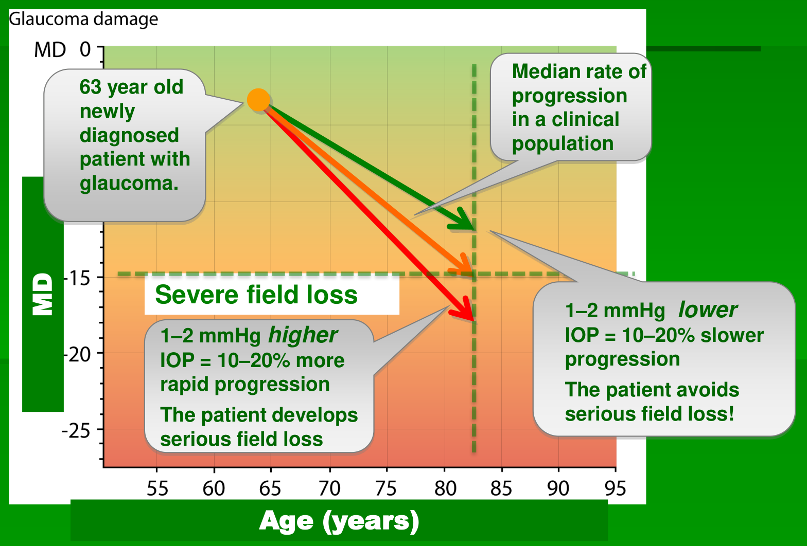 Chart of MD against age showing how 1-2 mmHg higher or lower IOP changes the rate of field loss