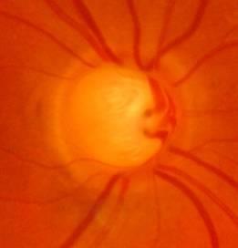 Photograph of an optic disc