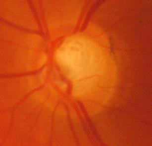 Photograph of a second optic disc