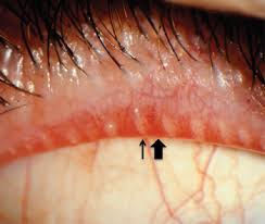 Lid margin with blocked Meibomian gland openings, thickened lid and telangiectasia (arrows)