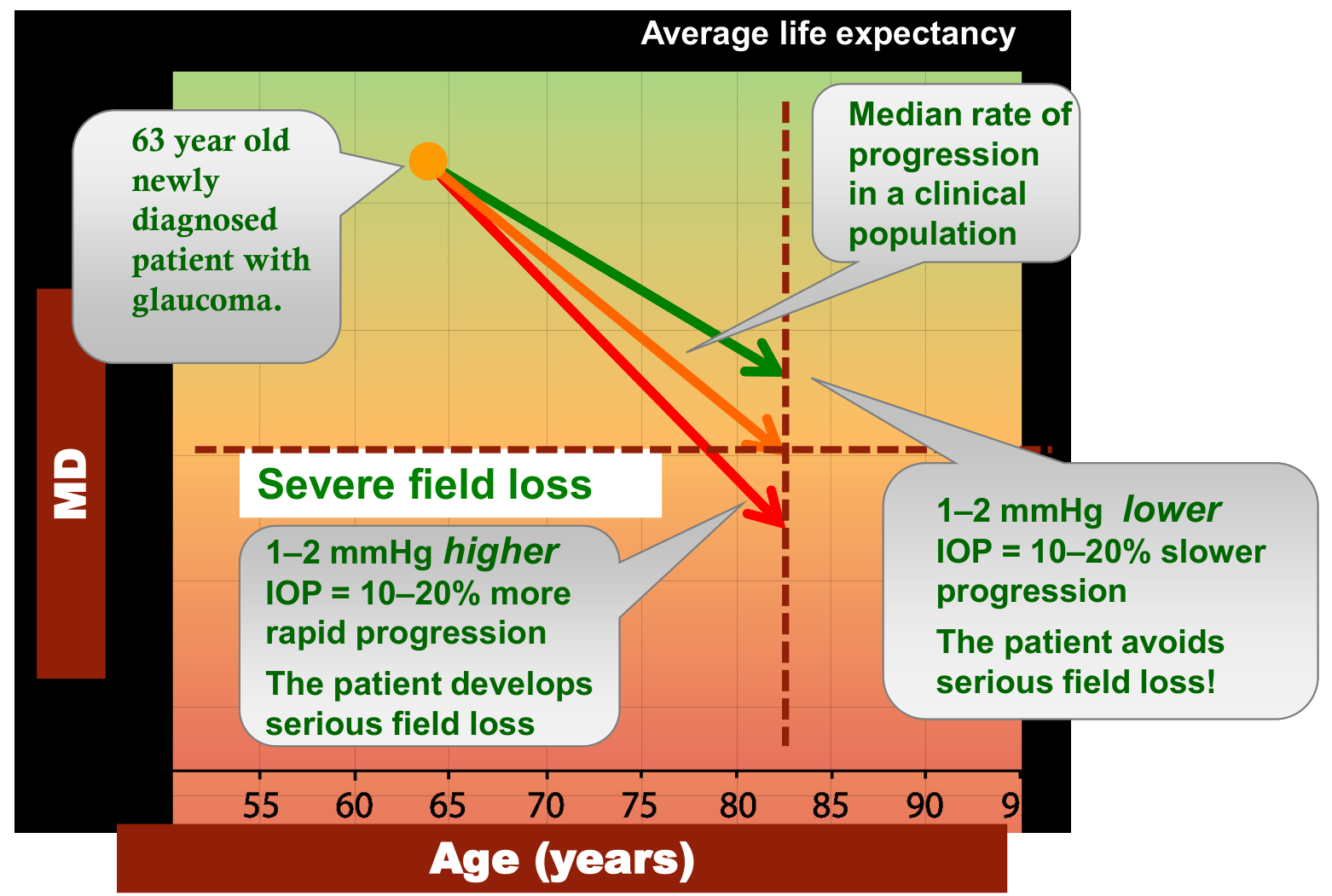 Graph of visual field loss against age showing the effect of 1-2 mmHg higher or lower IOP on glaucoma progression