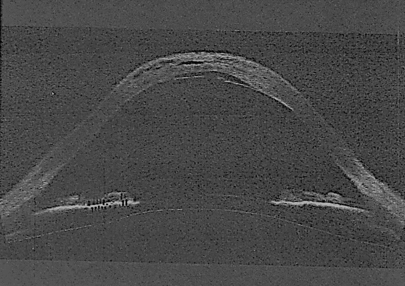OCT cross-section of the steep, thin keratoconic cornea