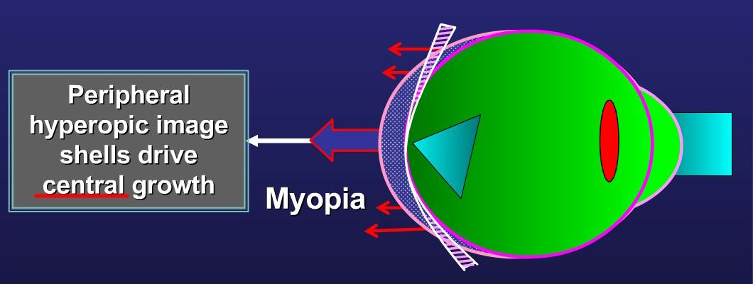 Diagram of a myopic eye with peripheral hyperopic image shells driving central growth