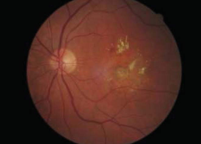 Fundus photo of progressive wet AMD