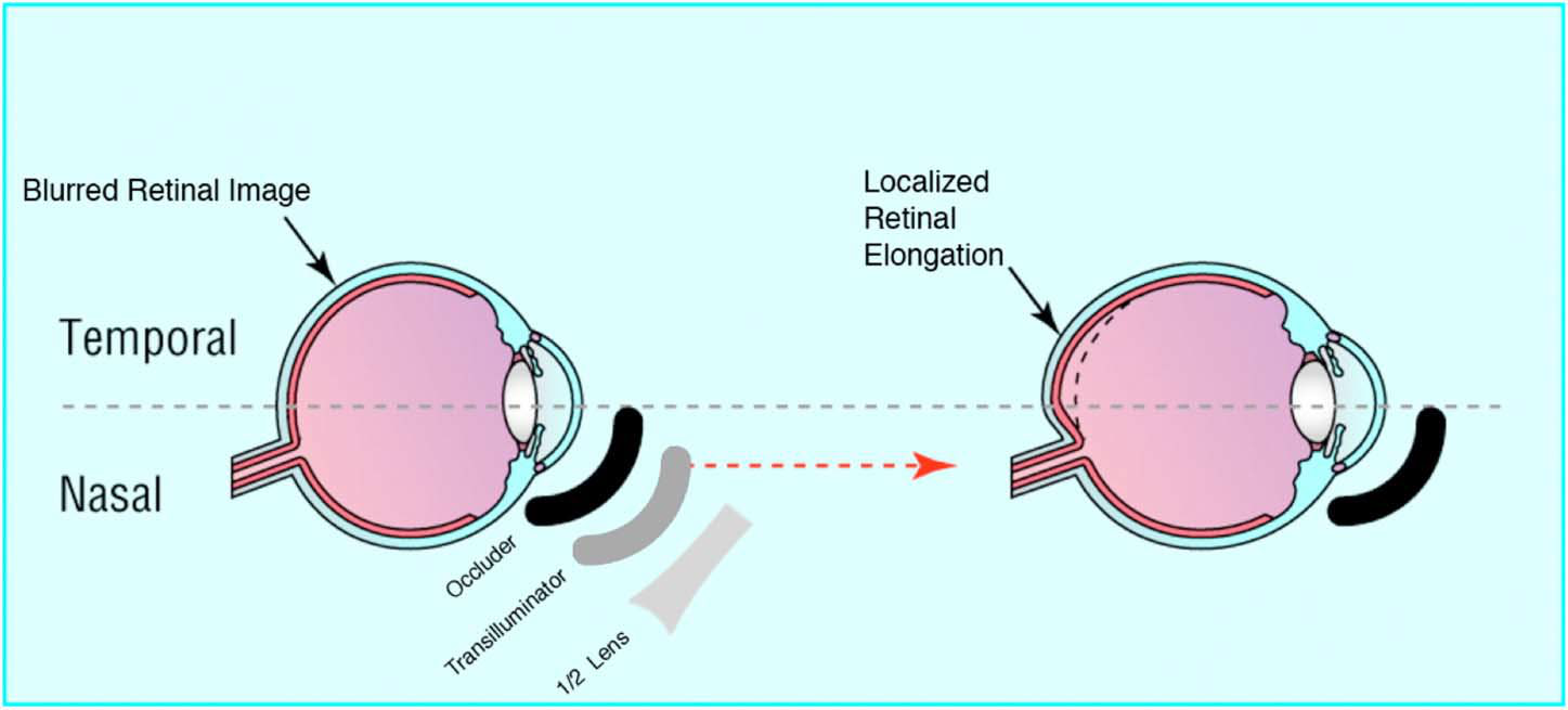 Diagram of regional retinal blur with a half lens causing localized retinal elongation
