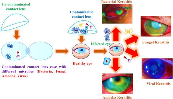How a contaminated contact lens can lead to bacterial, fungal, viral or amoeba keratitis