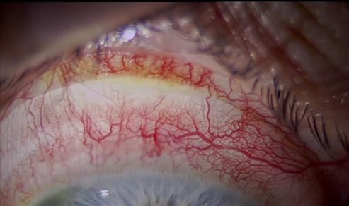Bulbar and limbal hyperaemia