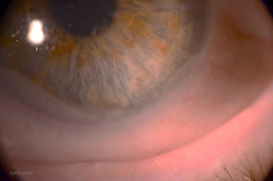 Conjunctival prolapse under a scleral lens