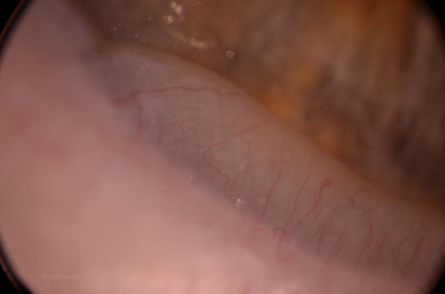Close-up of conjunctival prolapse