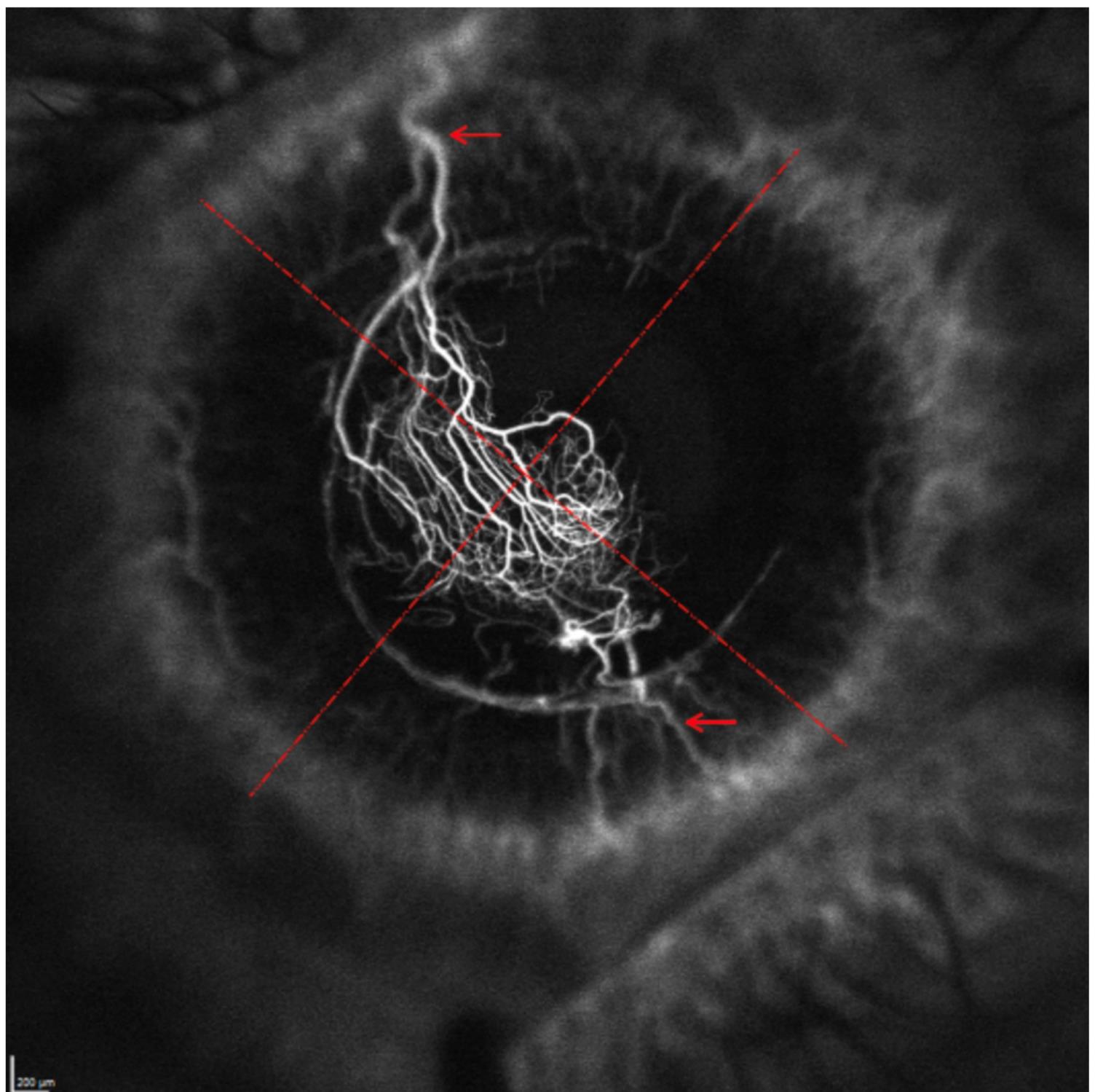 Angiography of corneal neovascularization