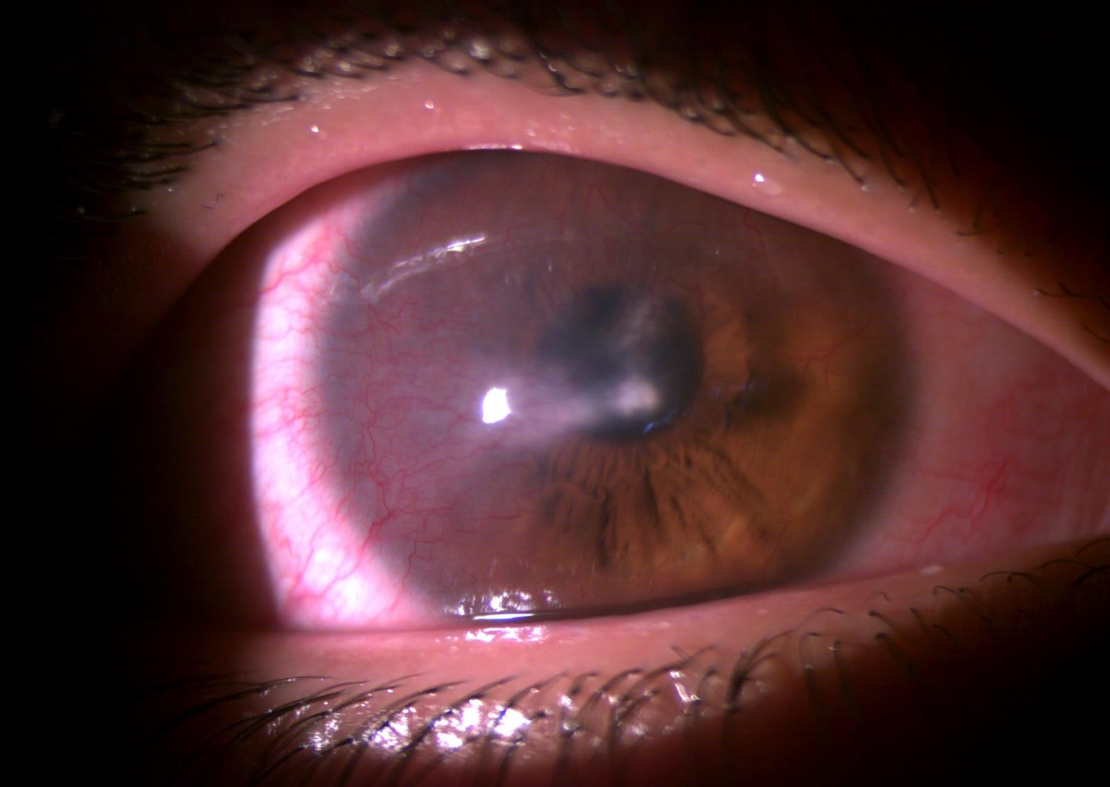 Corneal neovascularization