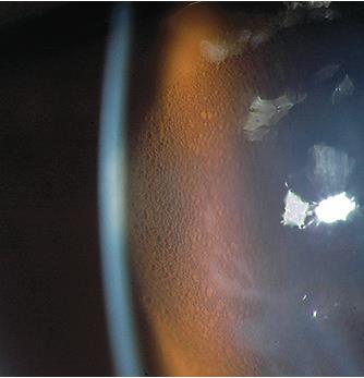 Slit lamp view of corneal swelling