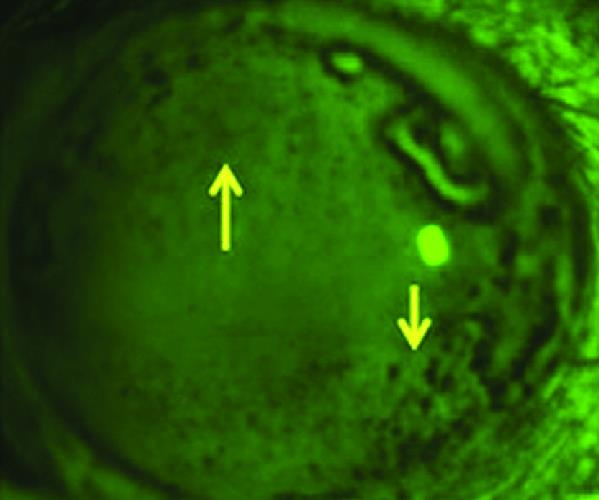 Epithelial bogging seen with fluorescein