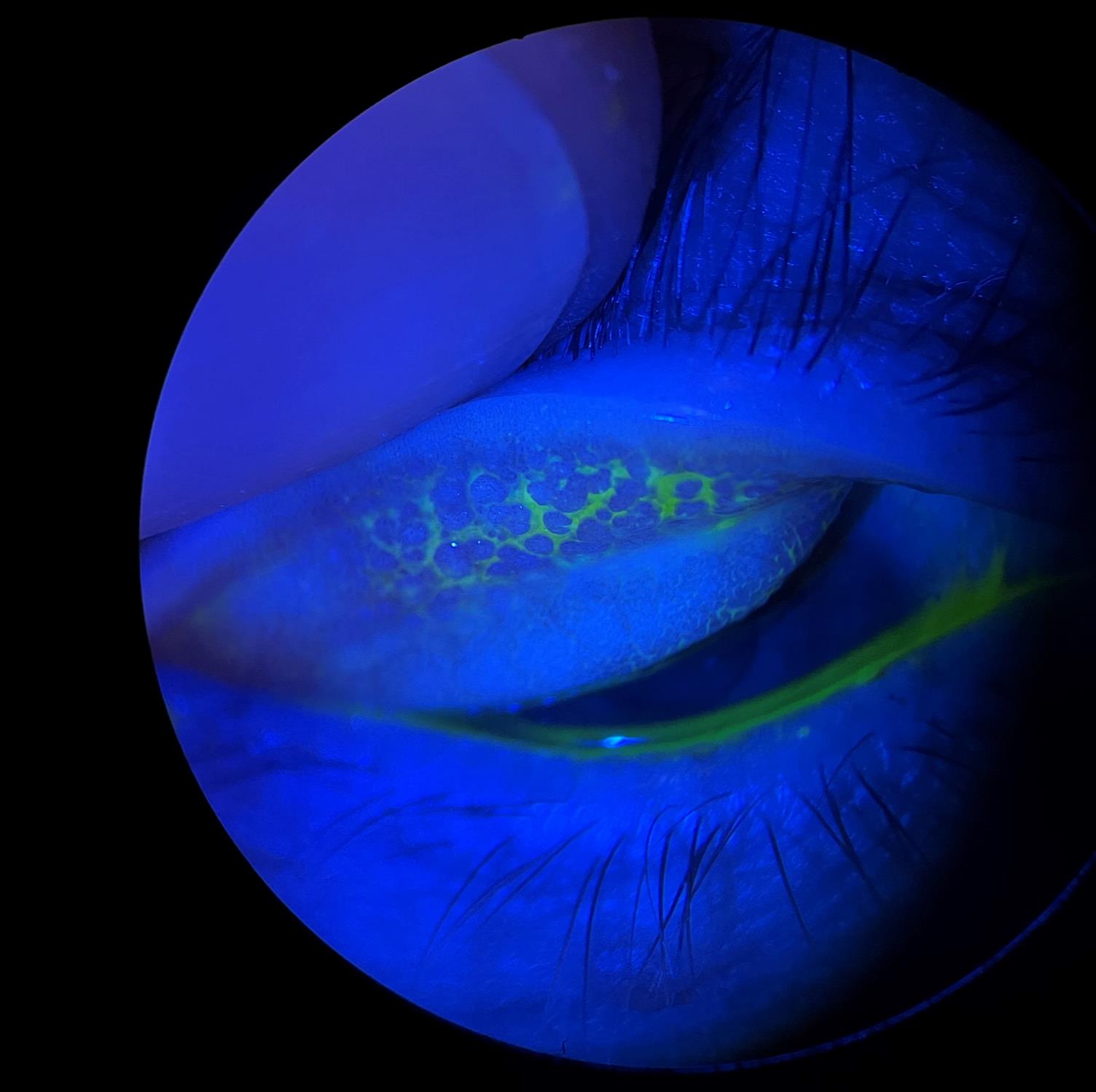 Everted upper lid with papillae stained with fluorescein