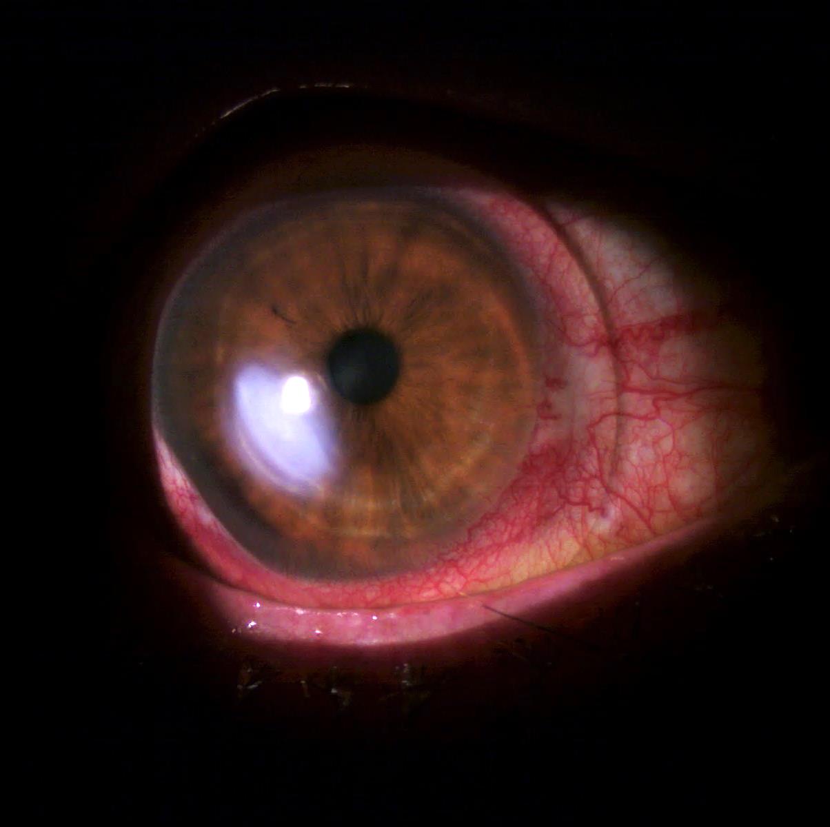 Inflamed red eye