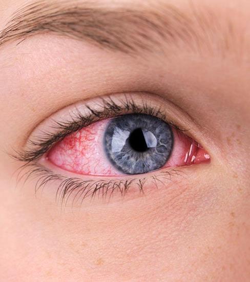 Red, inflamed eye