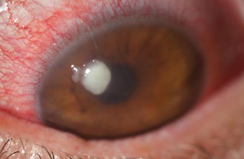 Corneal infiltrate in a red eye
