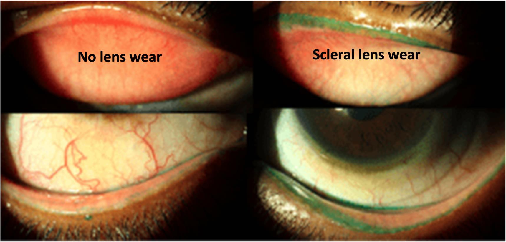 Lid wiper staining with no lens wear and with scleral lens wear