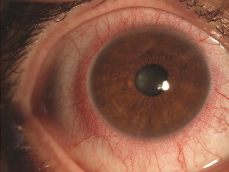 Eye with limbal hyperaemia
