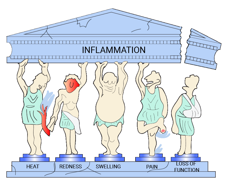 The signs of inflammation as pillars: heat, redness, swelling, pain and loss of function