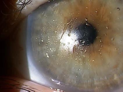 Scleral lens with surface deposits and poor wetting