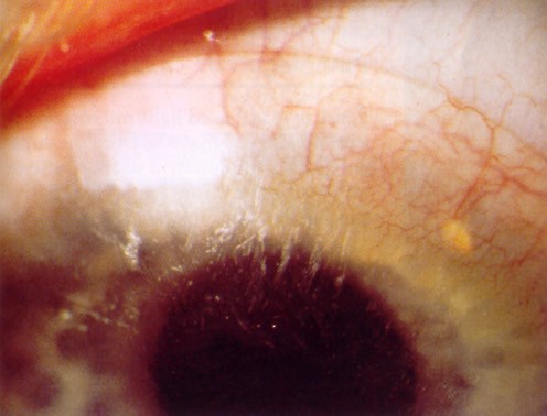Slit lamp photo of limbal and conjunctival hyperaemia from a thimerosal hypersensitivity reaction